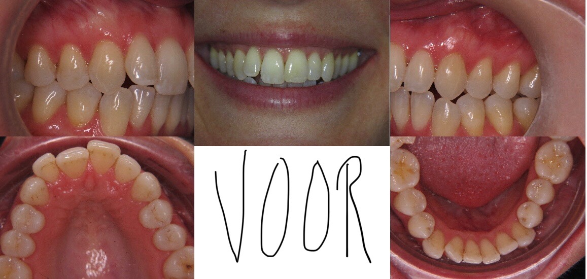 terug Tarief Verkeerd Orthodontie - Onze behandelingen | De Drietand - Maastricht